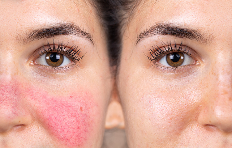 A comparison photo of a woman with rosacea, showing redness and visible blood vessels before treatment, and clear, smooth skin after laser therapy.