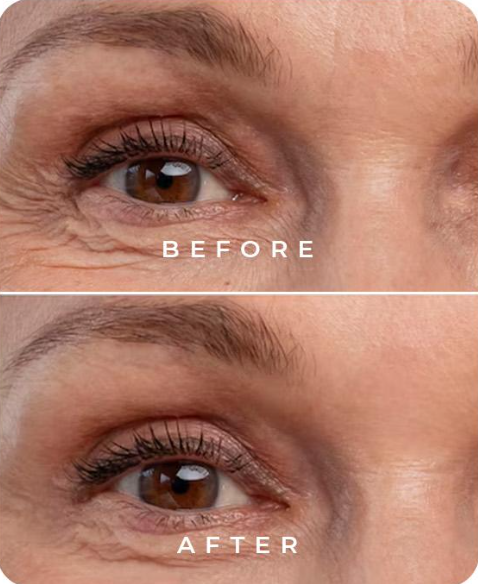 Best Botox Treatment in Chelsea and Battersea for under the eyes.