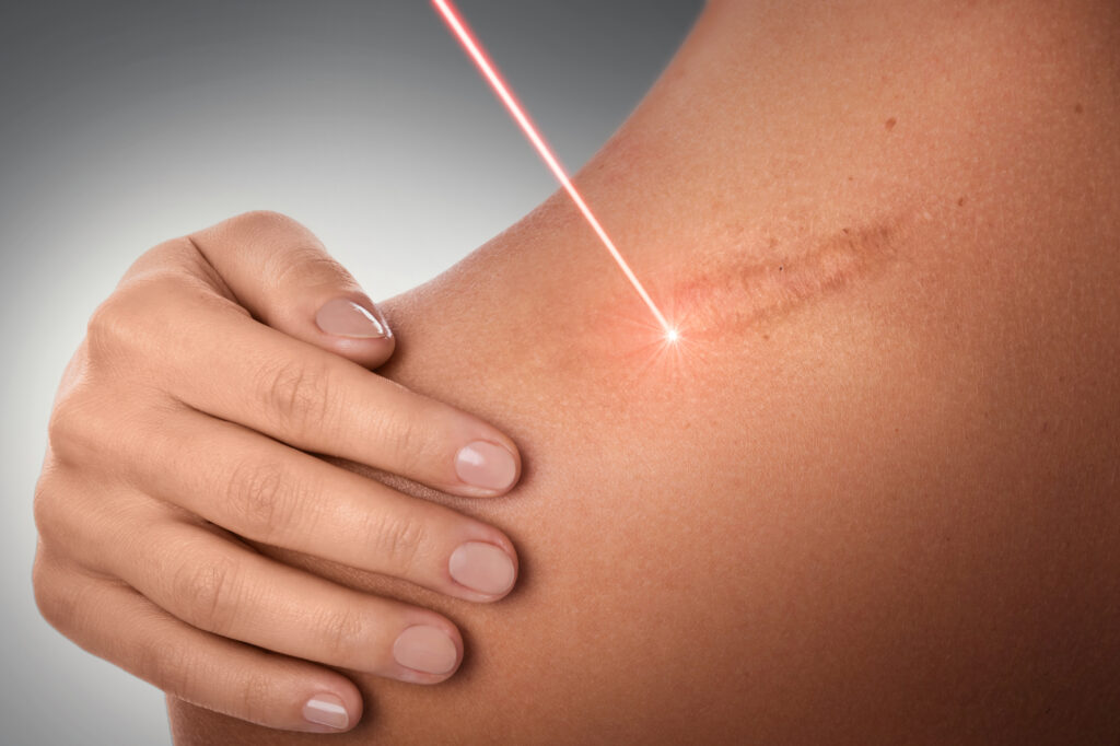Transformative Laser Scar Treatment: Beyond Skin Deep