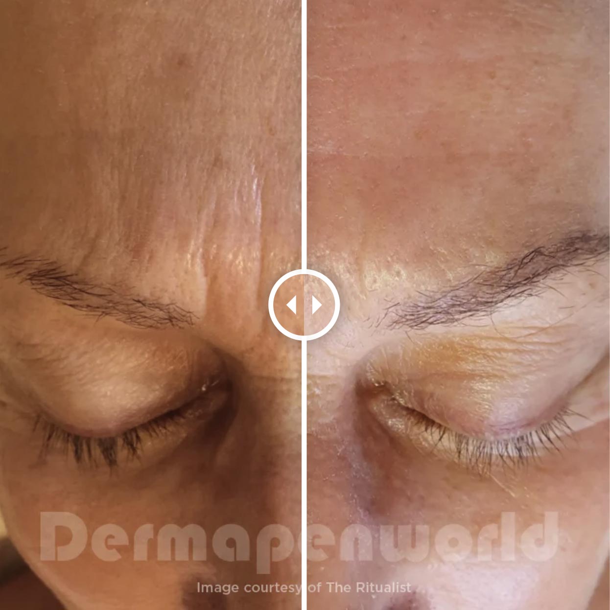 Dermapen fine lines and wrinkles 1