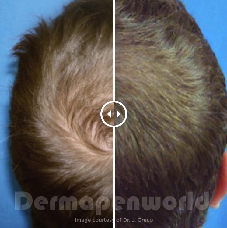 Dermapen hair loss 2