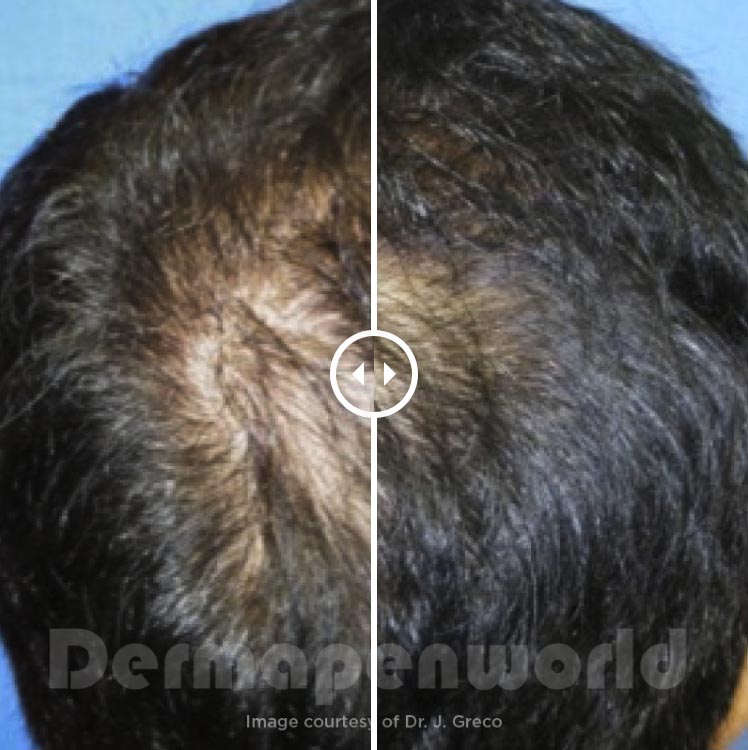 Dermapen hair loss 3