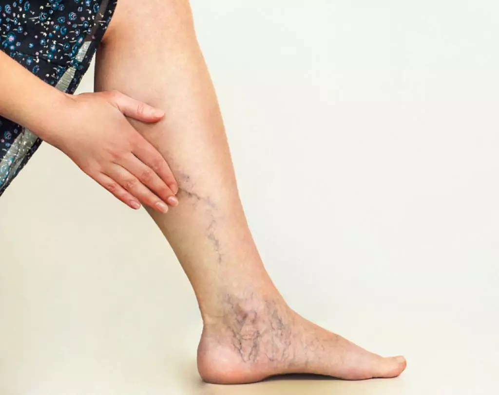 Leg rash Leg discoloration 1024x812 1