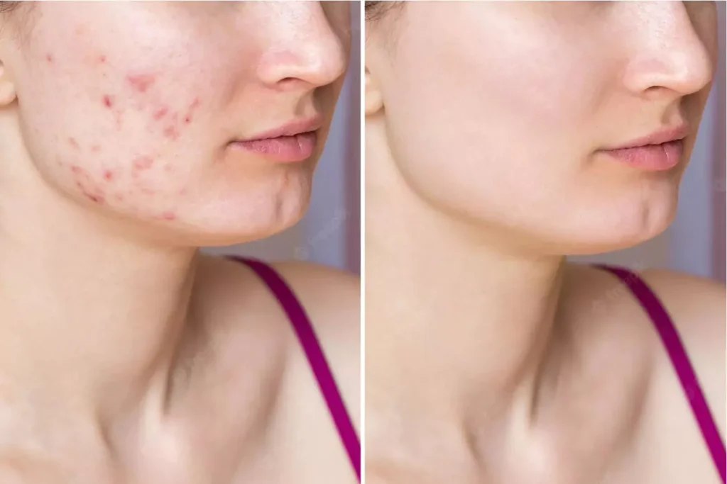 cropped shot young woman s face before after acne treatment face problem skin health care 407348 1941