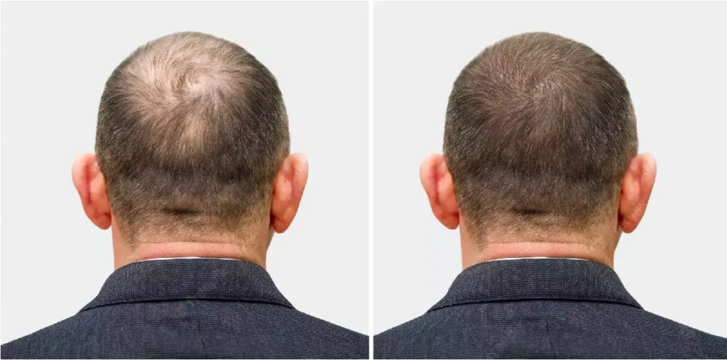 head balding man before after hair transplant surgery man losing his hair has become 168410 1967