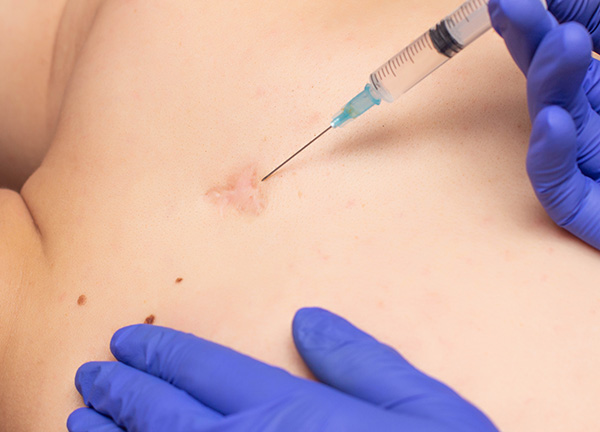 steroid injection for scars