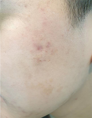 Acne photo after Exosome treatment