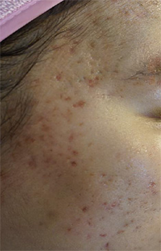 Acne photo after Exosomes treatment