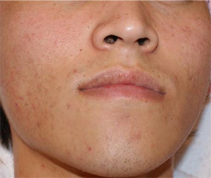 Acne after Exosome Therapy