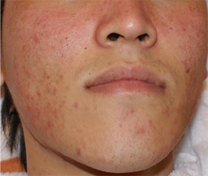 Acne before Exosome Therapy