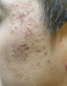 Acne photo before Exosome treatment