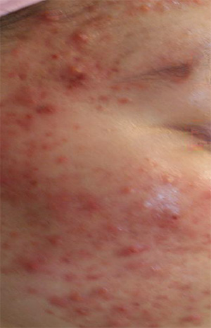 Acne photo before Exosomes treatment