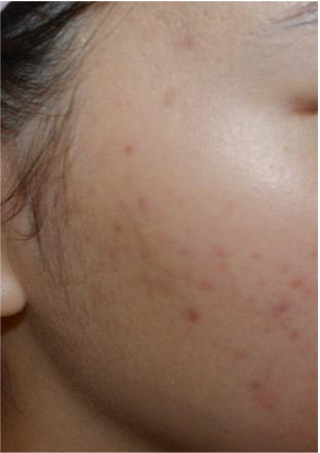 Acne after photo