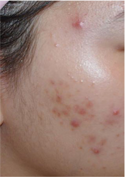 Acne before photo