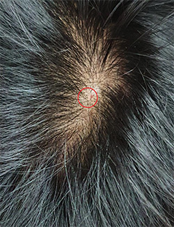 Exosome Hair Therapy After