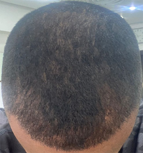 Exosome Hair Treatment After Photo 2