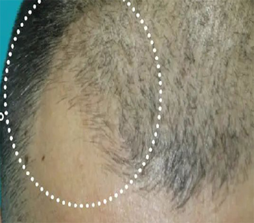 Exosome Hair Treatment After Photo 3