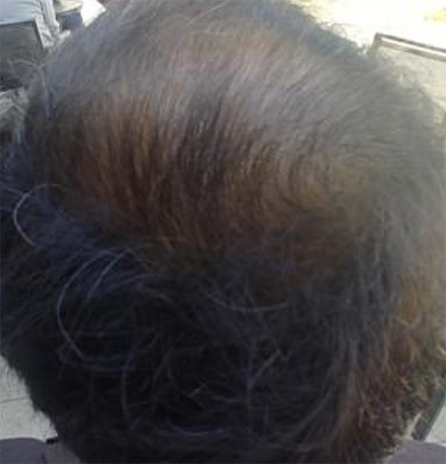 Exosome Hair Treatment After Photo