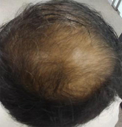 Exosome Hair Treatment Before Photo