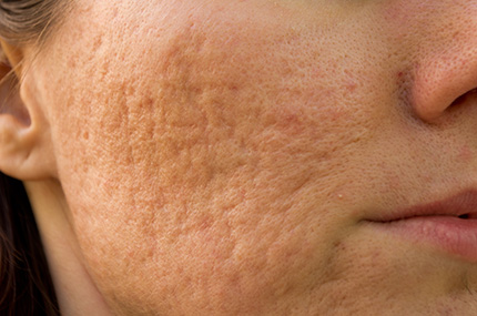 Image of acne scars on the cheek, highlighting the textured and uneven skin surface.