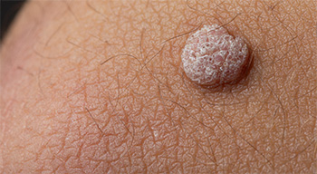 A close-up image of a skin wart showing its rough, raised texture and distinct appearance.