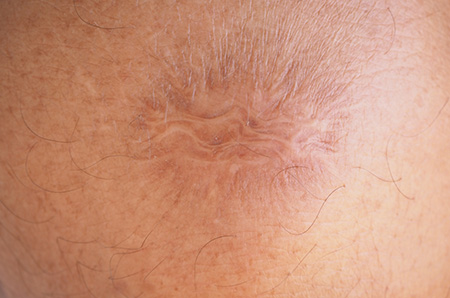 Image of a contracture scar on the forearm, showing tight, shiny skin causing restricted movement.