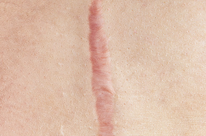 A hypertrophic scar on the forearm, characterized by a thick, raised appearance but confined to the wound area.