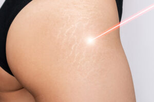 Laser Scar Removal