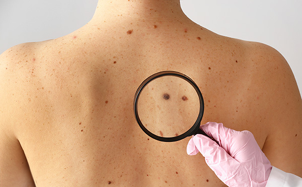 A dermatologist examining a woman's back for moles during a skin cancer check.