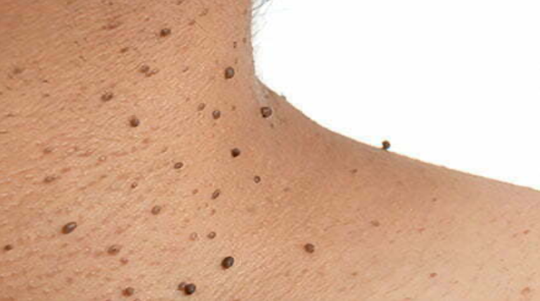 A close-up image showing small, benign skin tags on the shoulder and neck, with a smooth, flesh-colored appearance.