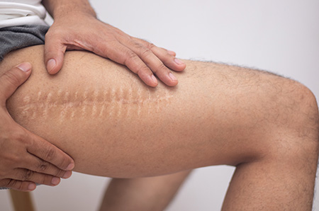 Surgical scar on the leg after a medical procedure, with a thin, linear mark indicating the incision site.