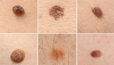 An image showing various types of moles on human skin, including flat, raised, irregular, and pigmented moles.