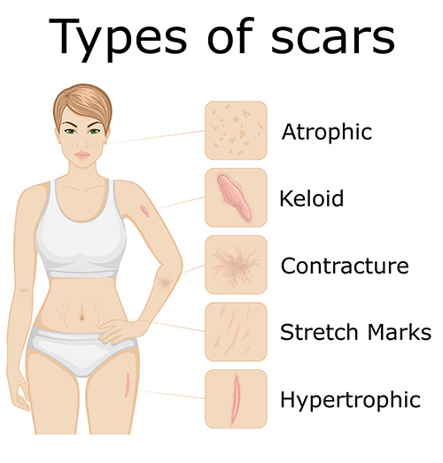 Illustration of different types of scars, including atrophic, keloid, contracture, stretch marks, and hypertrophic scars, highlighting their unique textures and characteristics.