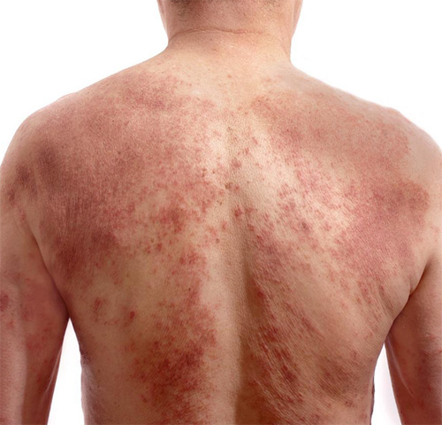 Atopic Dermatitis Treatment in Chelsea and Battersea