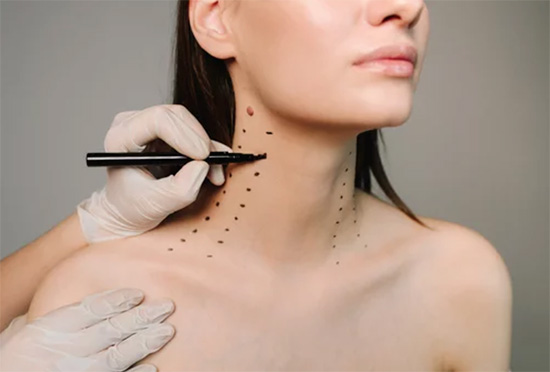 Botox Nefertiti Lift (Neck & Jawline Rejuvenation) treatment in Chelsea and Battersea