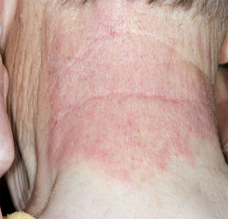 Contact Dermatitis Treatment in Chelsea and Battersea