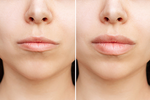 Dermal Filler Before & After 4