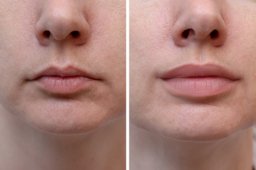 Dermal Filler Before & After 5