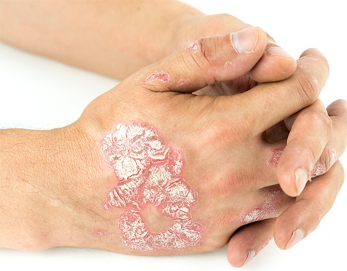 Erythrodermic Psoriasis Treatment in Chelsea and Battersea