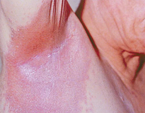 Inverse Psoriasis Treatment in Chelsea and Battersea