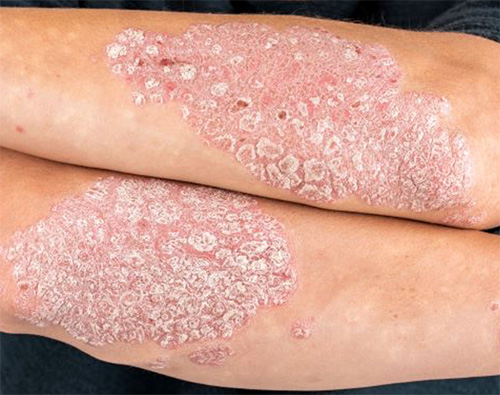 Plaque Psoriasis Treatment in Chelsea and Battersea