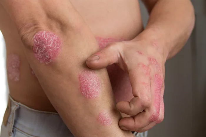 Psoriasis Treatment in Chelsea and Battersea.