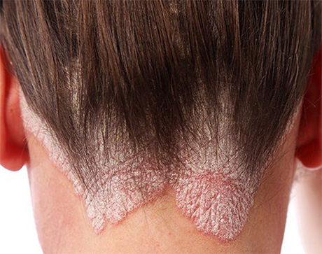 Scalp Psoriasis Treatment in Chelsea and Battersea