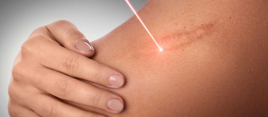 Laser Scar Treatment