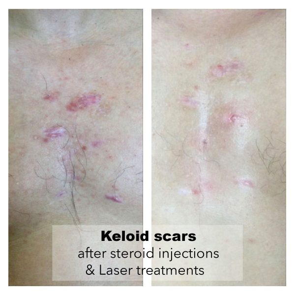 Keloid B A 002 3