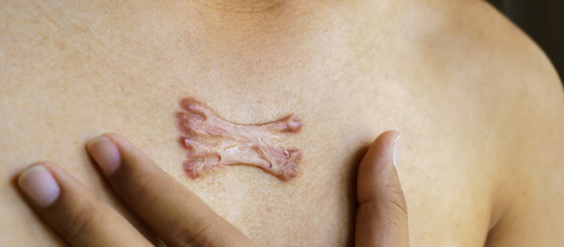 Keloid Scar