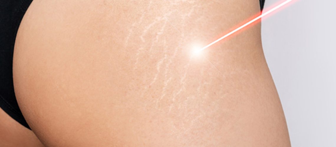 Woman undergoing laser scar removal treatment for stretch marks on her lower body.