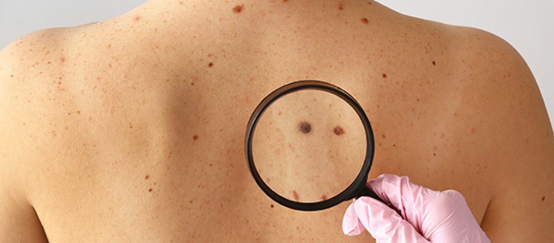 A dermatologist examining a woman's back for moles during a skin cancer check.